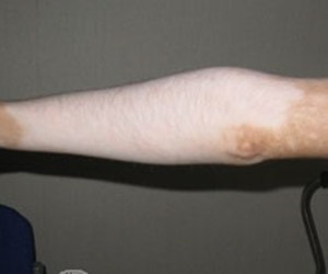 手臂白癜风有哪些症状