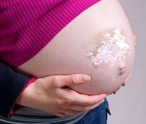 孕妇白癜风应该注意哪些方面
